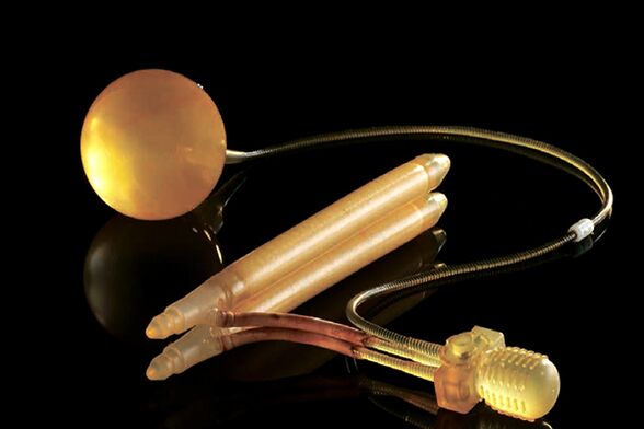 prosthesis Inflatable pikeun enlargement sirit bedah