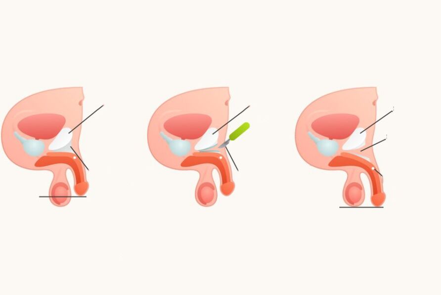 Ligementotomy ningkatkeun sirit
