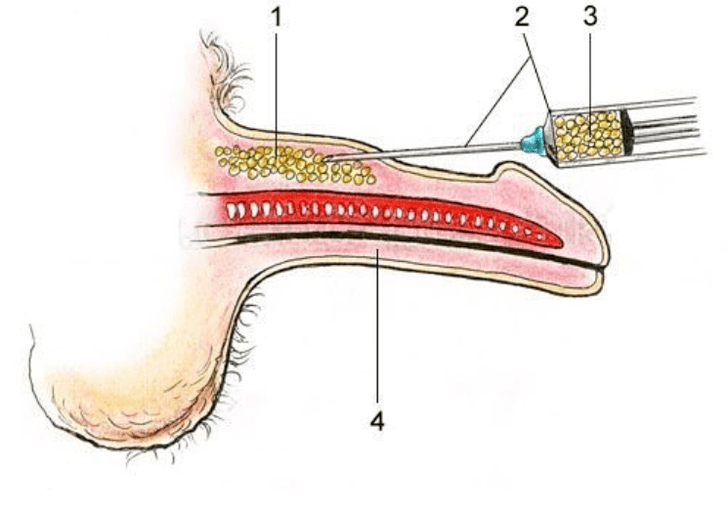 lipofiling pikeun ningkatkeun anggota