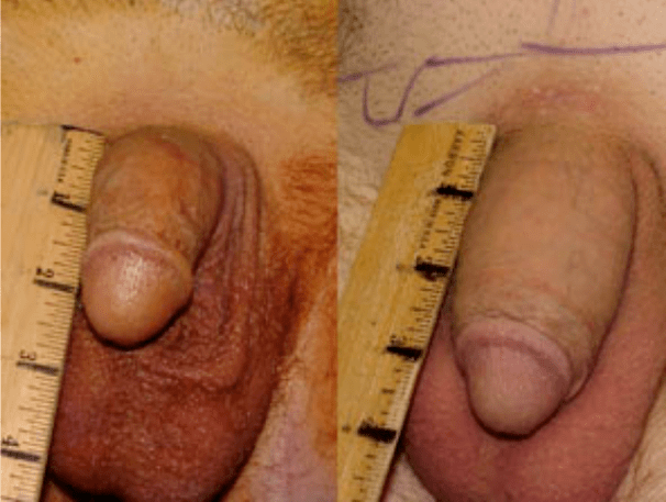 Sateuacan sareng saatos lipofilling sareng implantasi gél