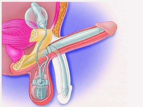Enlargement sirit ngaliwatan prosthesis penile
